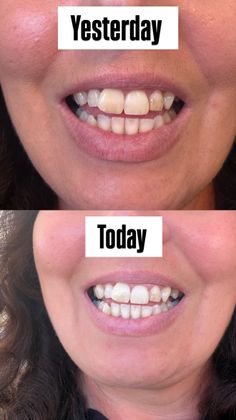 The difference one day makes to the whiteness of my teeth